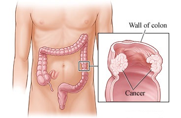 colon cancer treatment