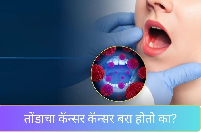 तोंडाचा कॅन्सर कॅन्सर बरा होतो का?