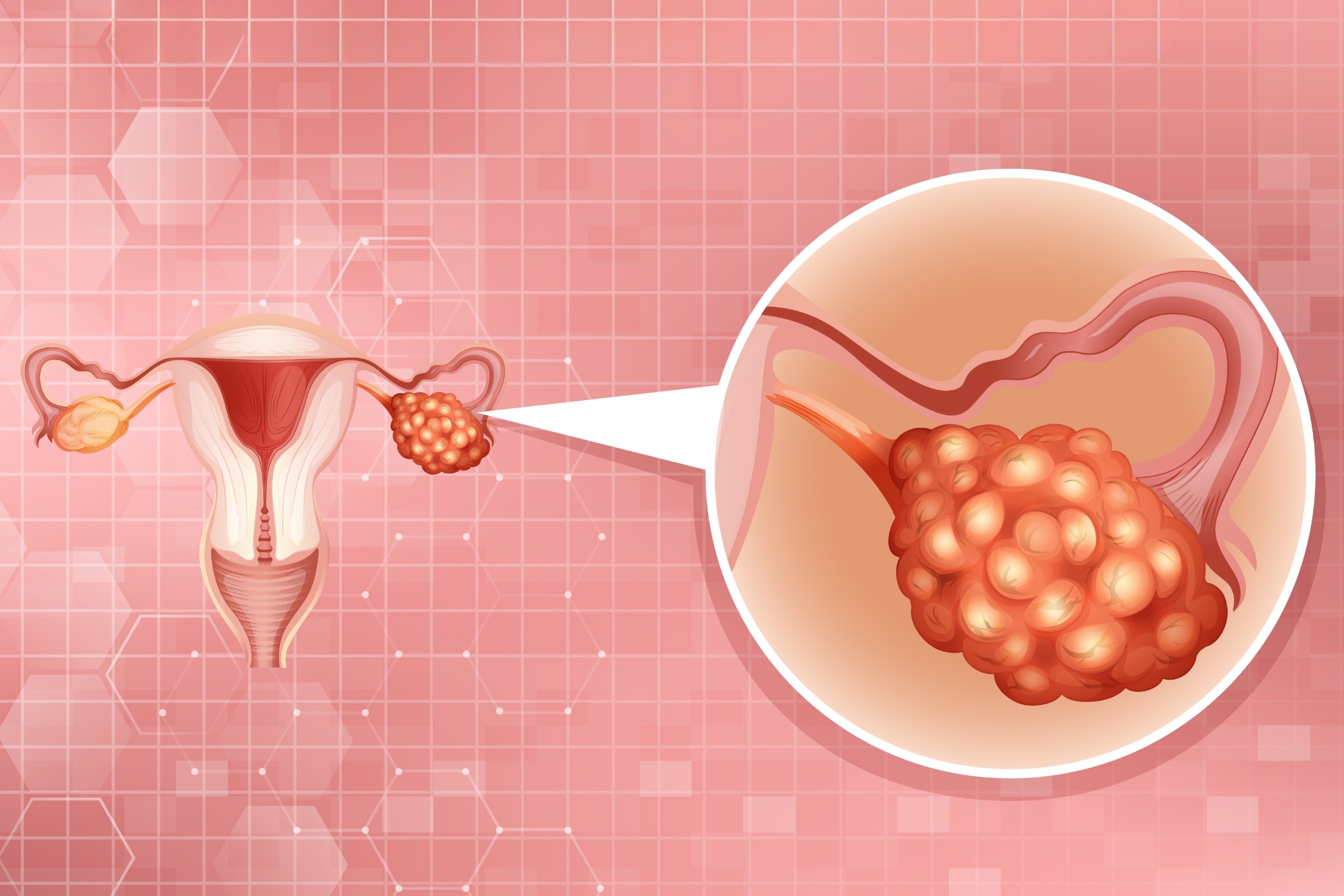 Gynecologic Cancer