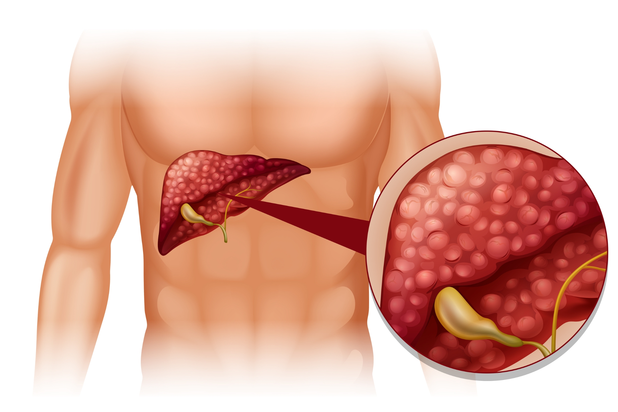 Hepato Pancreatico Billiary Cancer